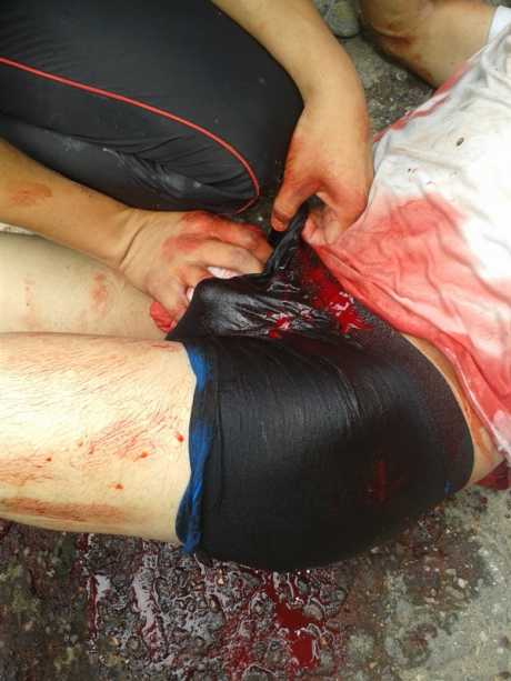 Image of one of those wounded by a bullet in Castilla, municipality of Coyaima (Tolima)